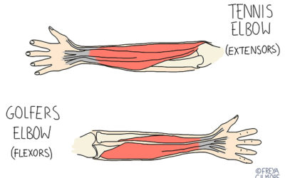 Golfer’s & tennis elbow: prevention, diagnosis and management