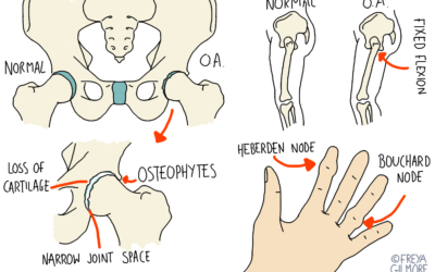 How osteopathy can help you manage osteoarthritis