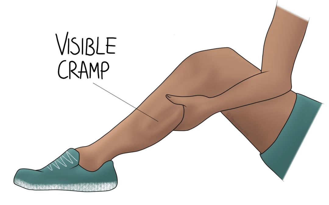 Visible cramp in calf muscle