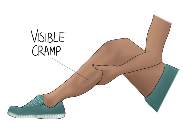 Visible cramp in calf muscle