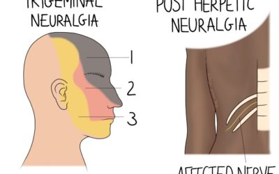 How osteopathy can help with symptoms of neuralgia