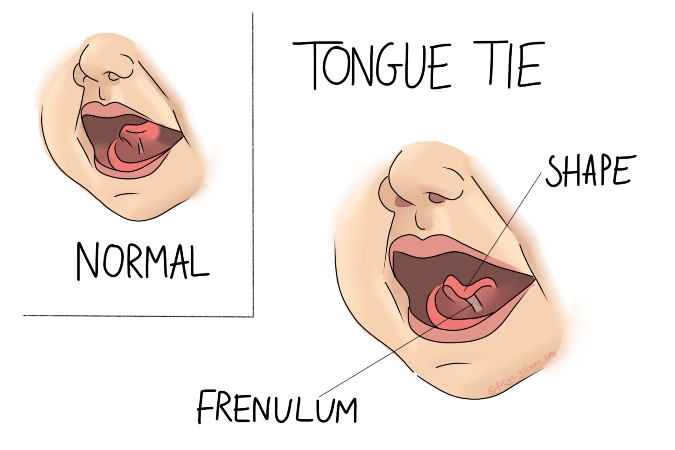 tongue tie graphic