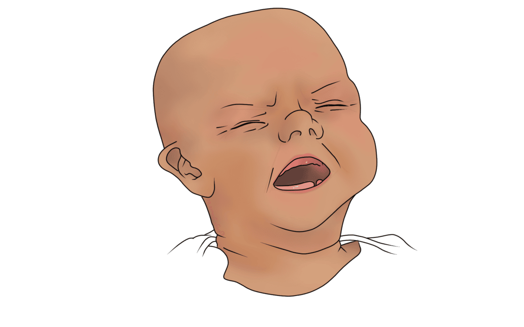 Infant Colic and Osteopathy